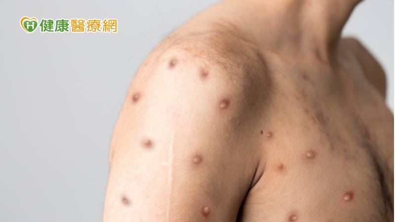 「猴痘」是病毒性疾病，此株病毒是天花病毒的親戚，症狀與天花相似，但病情較輕微，是人畜共通的傳染病。