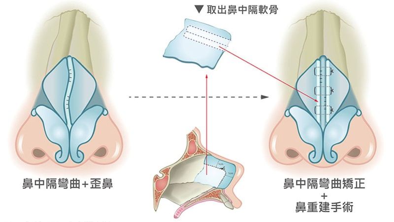 利用功能性結構式隆鼻一次解決歪鼻和鼻塞兩大問題
