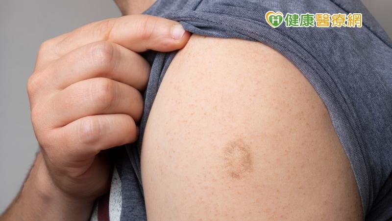 台灣常見施打的疫苗中，不少民眾不知道如何分辨天花疫苗與卡介苗的疤痕，疾管署也說明2種疤痕特徵，可供年紀大一點的民眾自我辨識。