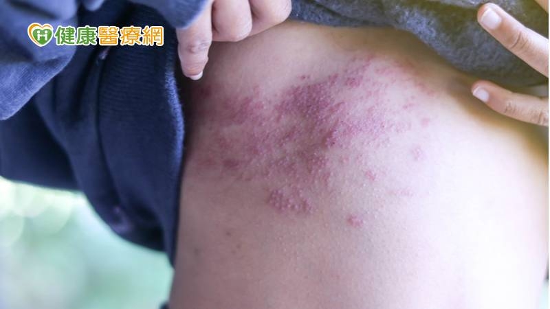 利用台灣健保資料庫進行全面廣泛的分析，研究結果顯示，在9032位器官移植患者中帶狀疱疹的罹病風險高達9.19倍；而當排除其他相關共病引發帶狀疱疹後，罹病風險為非器官移植患者的27.35倍