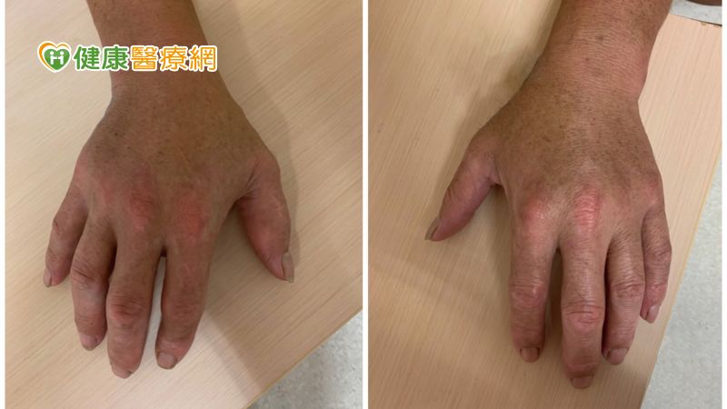 ▲右手大拇指明顯腫脹，俗稱香腸指。