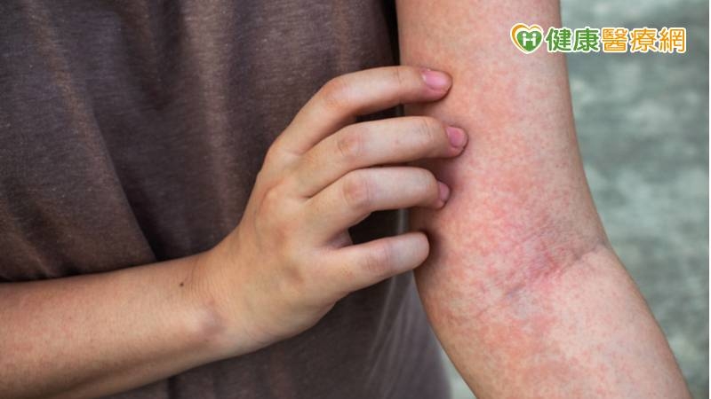 對於COVID-19疫苗引起嚴重藥物疹的病人，若是系統性類固醇治療效果不佳、產生明顯副作用或是有禁忌症者，免疫抑制劑-環孢靈可以作為良好的替代性治療藥物。