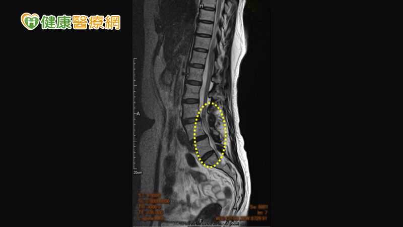 ▲椎孔是脊髓及神經的管道，腰椎狹窄是脊椎結構退化、進而壓迫到神經，出現痠麻刺痛