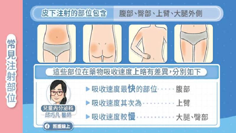 常見注射部位