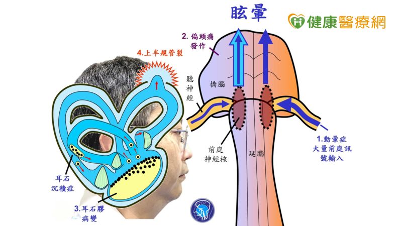 陳建志醫師解釋，搭飛機暈眩症有4大機轉，分別是動暈症、偏頭痛發作、耳石膠病變、上半規管裂等。  