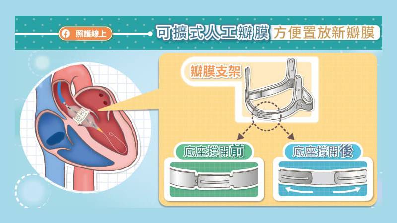 最新一代的可擴式乾式組織瓣膜