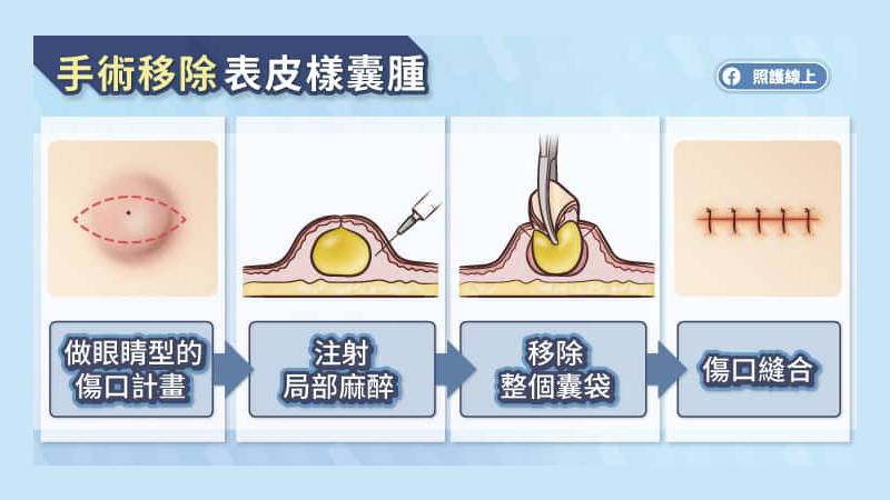 手術切除表皮樣囊腫