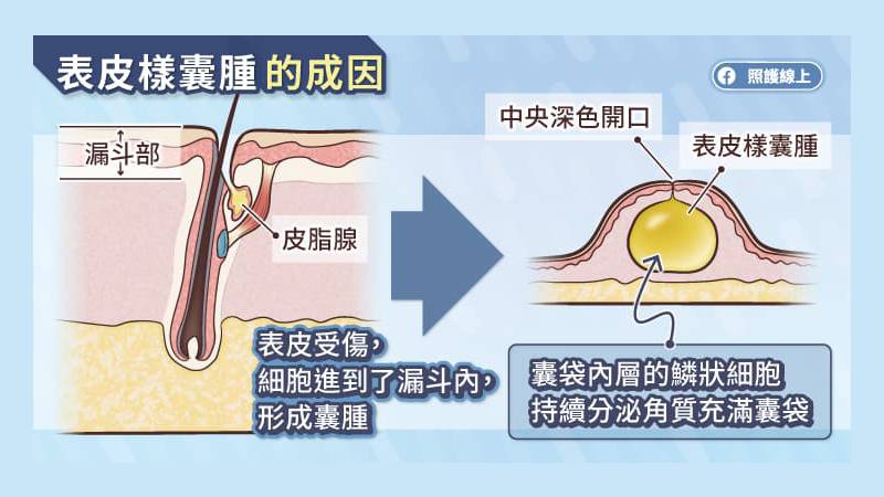 表皮樣囊腫成因