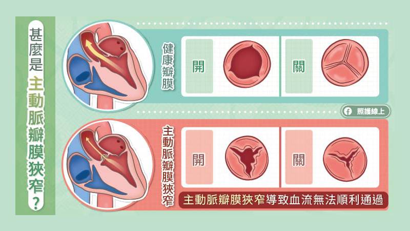 什麼是主動脈瓣膜狹窄?