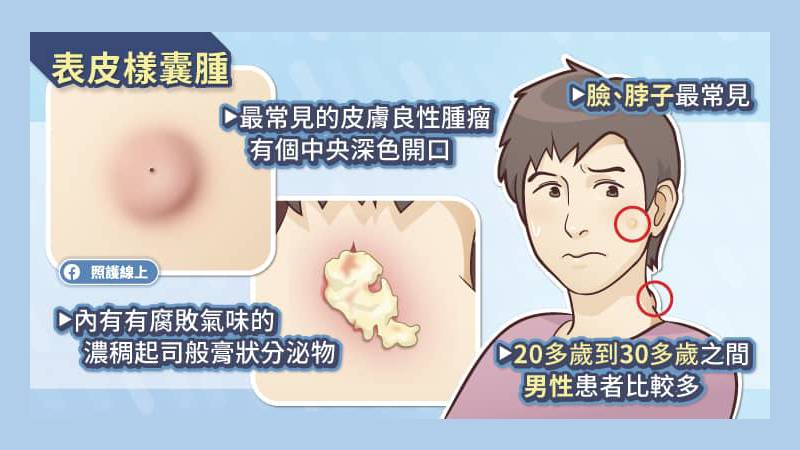 表皮樣囊腫