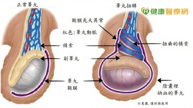 蔡伊達醫師表示，鞘膜先天異常者，較易發生睪丸扭轉