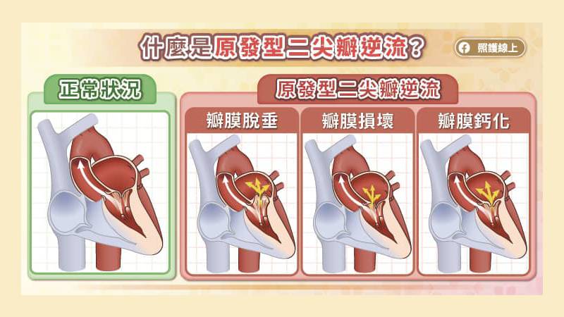 什麼是二尖瓣逆流