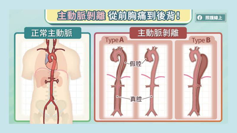 常見的主動脈疾病包括主動脈剝離、主動脈瘤。陳紹緯醫師說，主動脈剝離在亞洲人較常見，主動脈瘤西方人較常見。