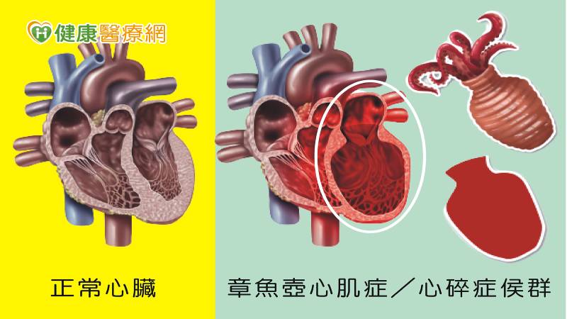 患者左心室呈現章魚弧形狀，疑似「章魚壺心肌症」或稱「心碎症侯群」。
