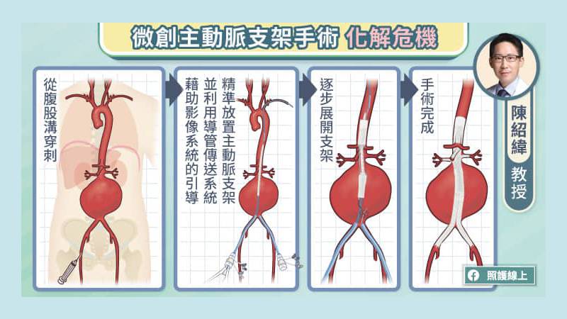 治療主動脈疾病，化解危機