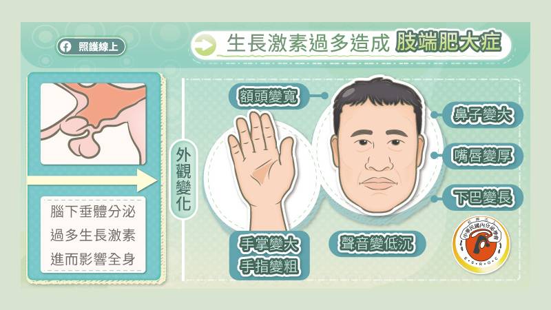 生長激素過多造成肢端肥大症