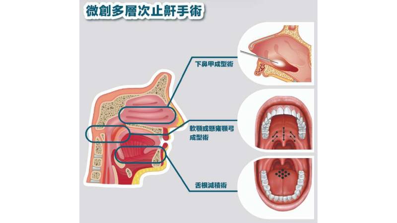 「微創多層次手術」是國內外止鼾手術推薦的療程