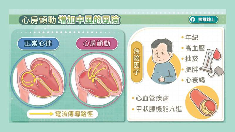 心房顫動增加中風的風險