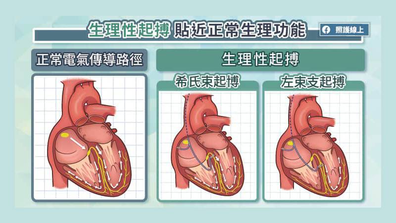 生理性起搏術式幫助維持心臟功能