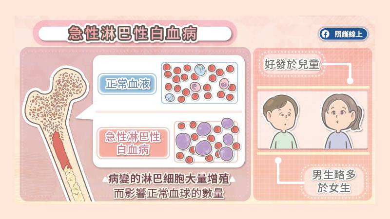 急性淋巴性白血病
