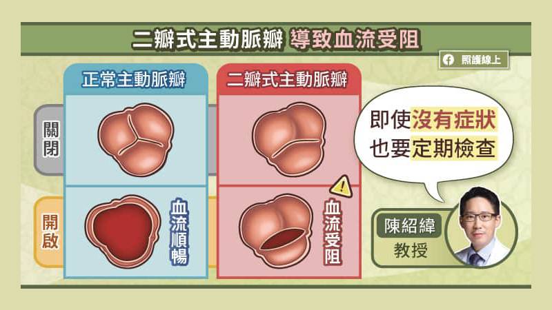 兩瓣式主動脈瓣出現主動脈瓣狹窄