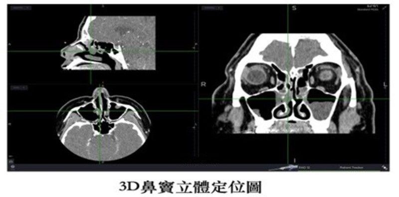 慢性鼻竇炎治療新科技　膠原蛋白基質粉輔助傷口癒合