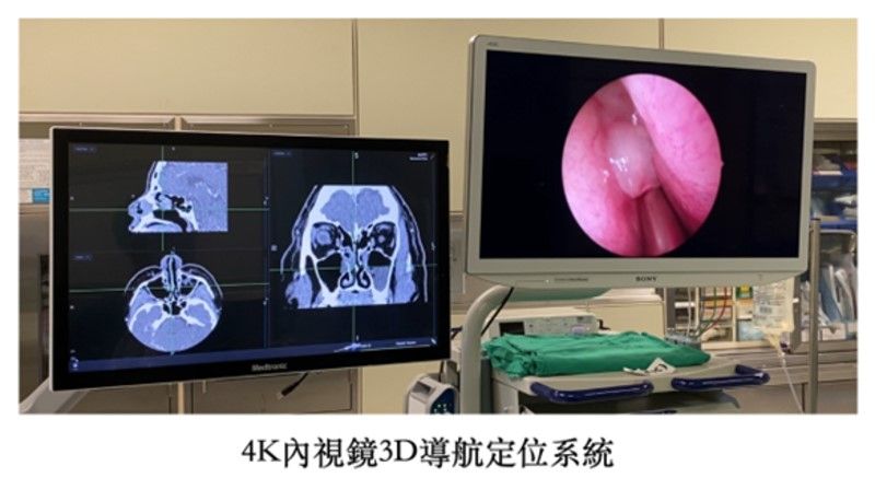 慢性鼻竇炎治療新科技　膠原蛋白基質粉輔助傷口癒合