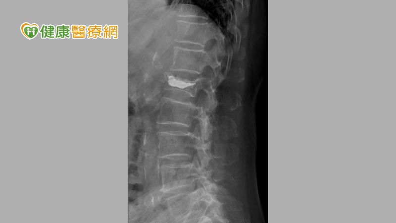 患者第一節腰脊椎(L1)，為骨質疏鬆合併脊椎壓迫性骨折，經治療，灌入骨水泥支撐塌陷的椎體後，復原狀況良好
