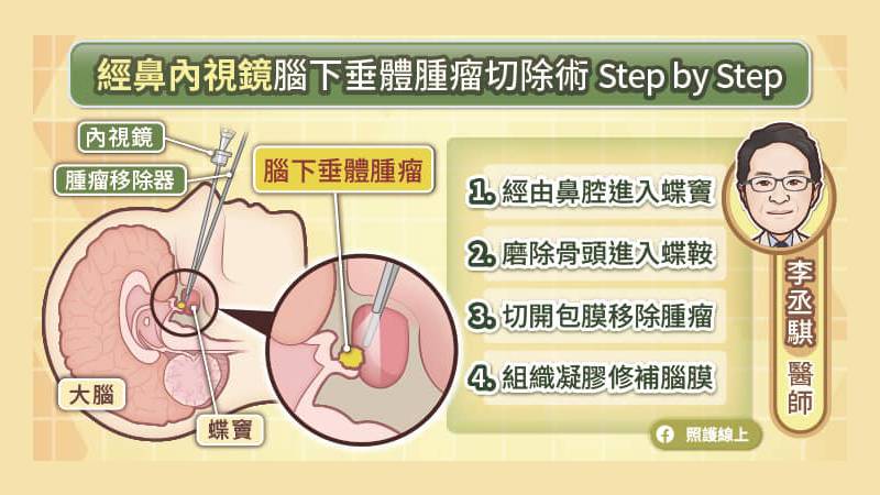 經鼻內視鏡腦下垂體腫瘤切除手術