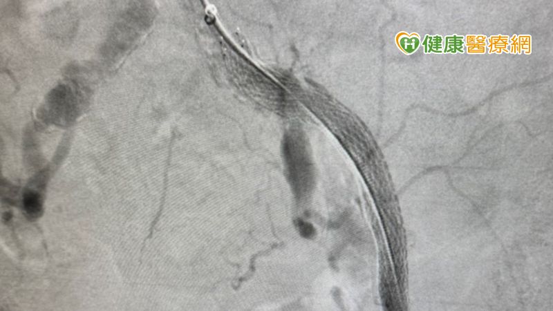 朱新凱醫師表示，臨床上很常可以看到同一條血管多段堵塞的患者，醫師會評估最適合患者的治療方式(圖為使用支架放置術撐開血管)。（圖／健康醫療網提供）