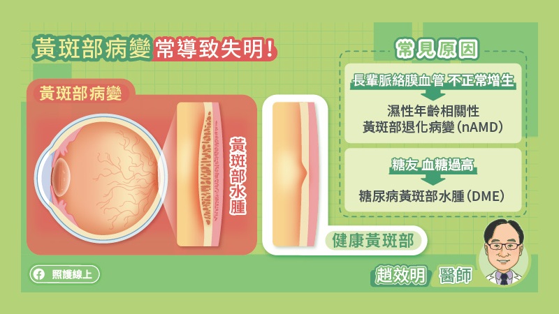 的黃斑部病變 常導致失明