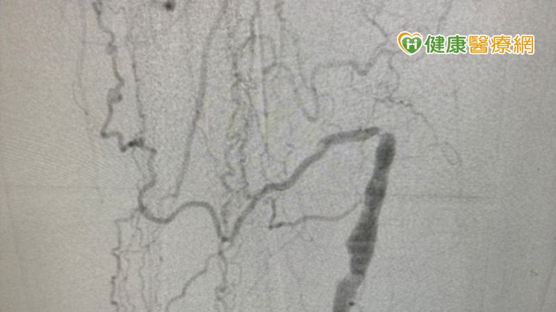 患者因下肢動脈血管阻塞，血液代償性繞道由較小的血管通過，造成血流比一般人小，會出現腿部無力、麻、冷或是間歇性跛足等症狀。（圖／健康醫療網提供）