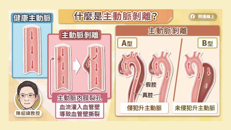 什麼是主動脈剝離？