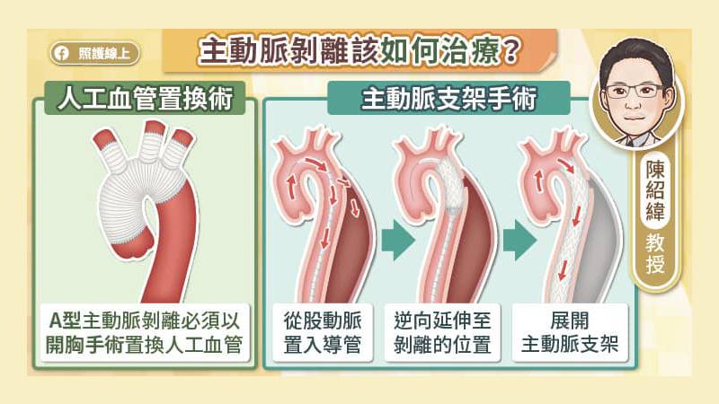 主動脈剝離如何治療？