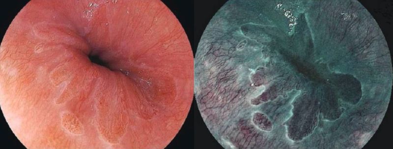 右圖為高解析度BLI內視鏡影像系統，可很清楚看到胃食道交接處粘膜及微血管非常細微構造及變化。（圖／健康醫療網提供）