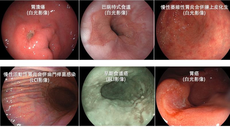 透過胃鏡，醫師可清楚觀察食道、胃部及十二指腸，看是否有發炎、潰瘍、息肉、腫瘤或癌變等疾病。（圖／健康醫療網提供）