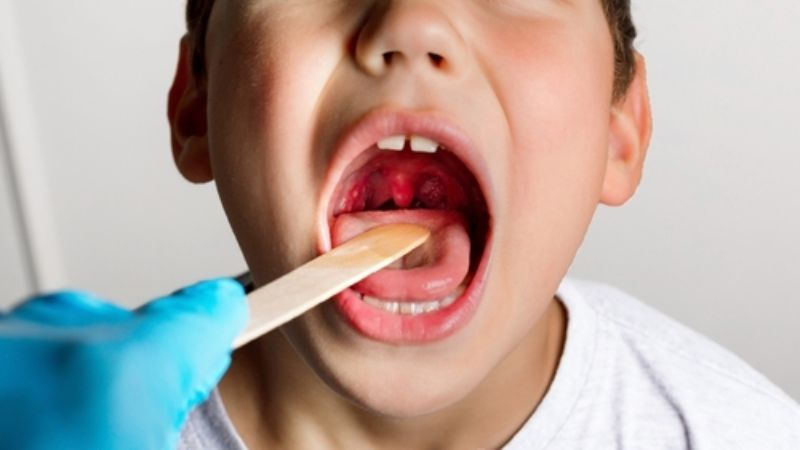 喉嚨痛≠感冒！　高燒不退、頸部脹痛恐是「扁桃腺發炎」嚴重會致命！8大症狀、6招舒緩一次看