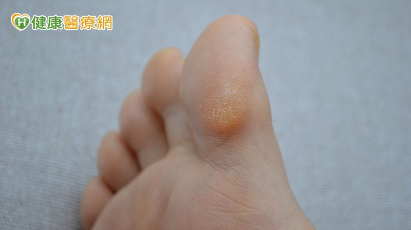 厚繭即俗稱的雞眼對及早發現糖腳有很大幫助，正常人腳底有厚繭的話會自然避免踩踏痛處，經過一段時間後由不尋常壓力所引起的厚繭就會逐漸消失。可是對糖足患者而言，因著腳底觸感已不敏感就會持續踩踏厚繭，結果就容易受損及形成潰瘍。