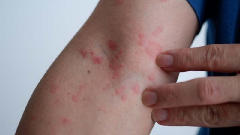 熱過敏即「膽鹼型蕁麻疹」（Cholinergic Urticaria），是一種皮膚疾病。
