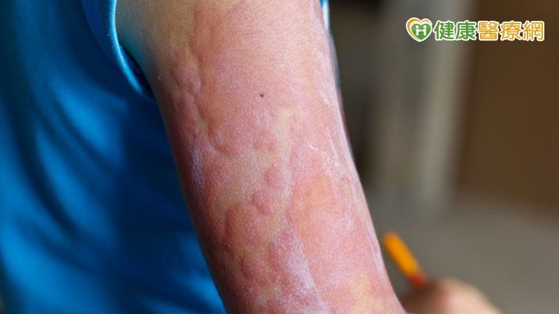 異位性皮膚炎病人都要重視日常的基礎保濕護理，使用乳液、凝膠、軟膏等保濕產品有助於維持皮膚屏障的完整性，有效降低發炎的機率。