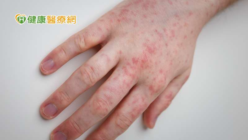 國內新增1例麻疹本土病例、2例境外移入病例，今（2025）年已經累積共22例麻疹病例。