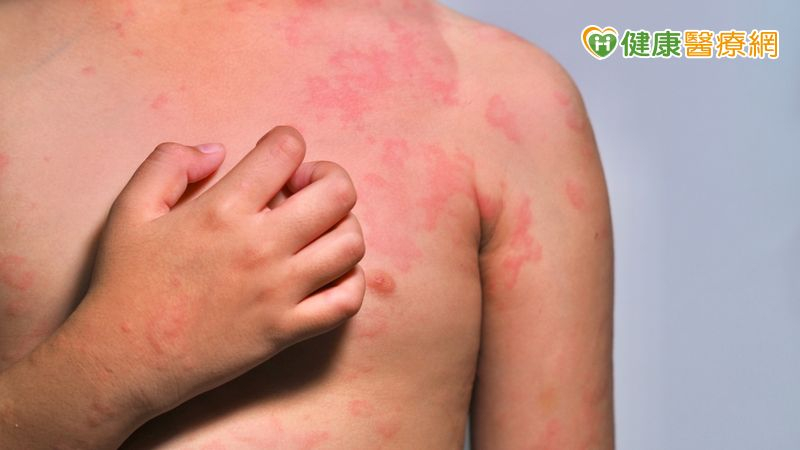 人體中，特異性IgE抗體在遇到過敏原，產生反應並與之結合後會使身體釋放發炎因子而造成過敏的症狀，影響我們的日常生活。