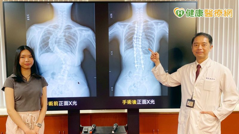 黃姓女僑生（左）脊椎側彎達90度，台中榮總骨科部脊椎外科主任潘建州（右）為她進行脊椎機械手臂手術，成功矯正。（中華新聞雲記者陳金龍攝）