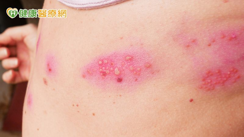 俗稱「皮蛇」的帶狀皰疹，發作起來劇痛無比，接種帶狀皰疹疫苗可以降低發作風險和發作時的疼痛。