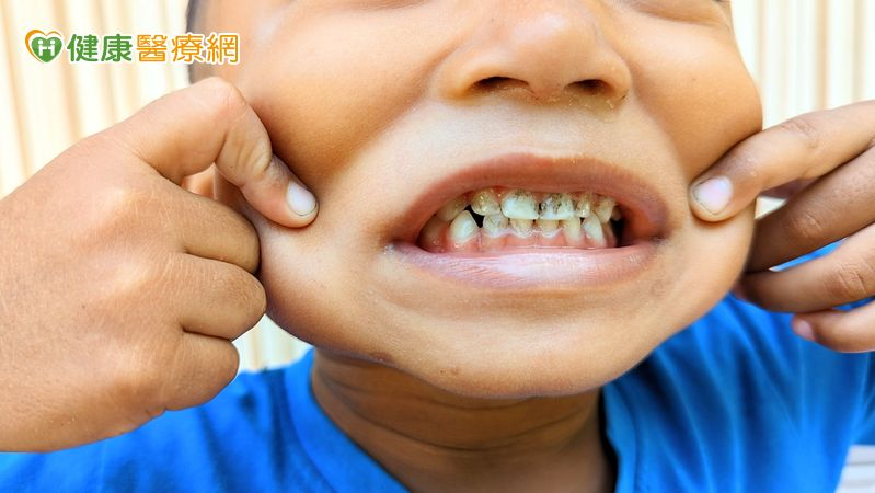 染色不等於「免蛀」，若口腔衛生不佳，還是會發生齲齒。