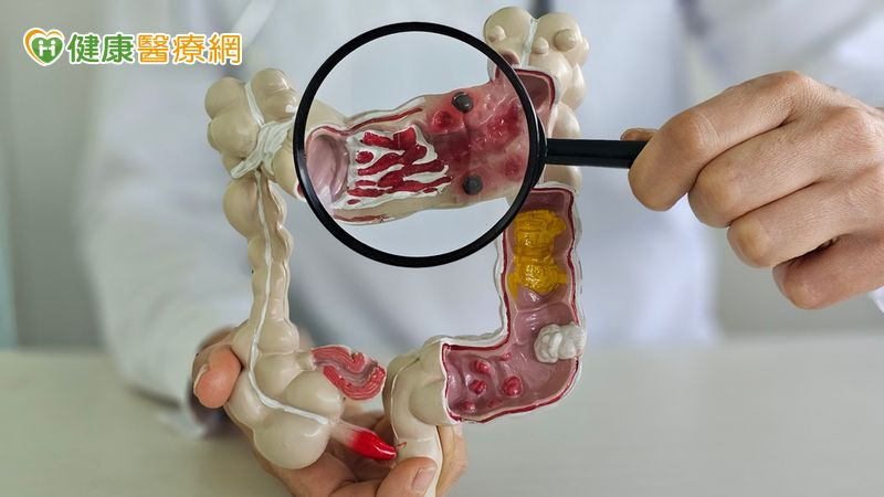 台灣中壯年大腸癌飆高，專家肯定下修篩檢年齡是正確決策。