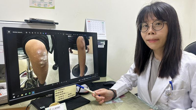 豐原醫院中醫師蘇紋華表示，乾癬並非傳染病，而是免疫系統失調導致的皮膚疾病。（中華新聞雲記者徐義雄攝）