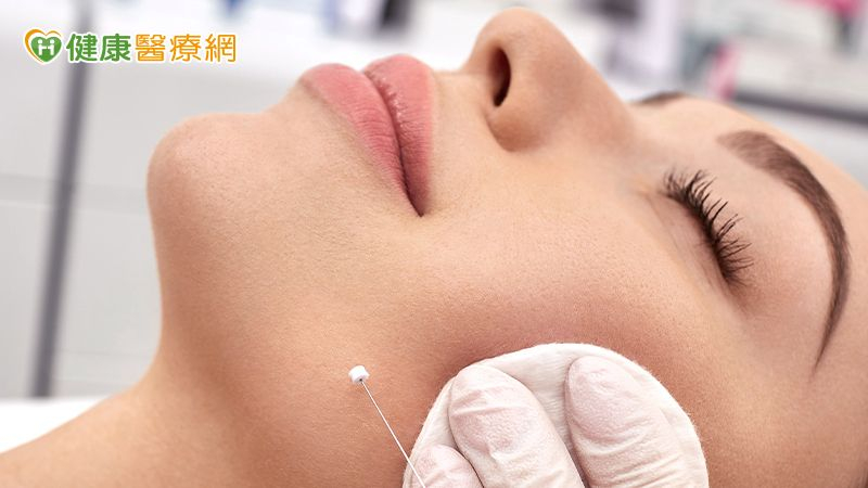 知名YouTuber「蒼藍鴿」（吳其穎）說明，埋線拉提透過可吸收線材拉提並刺激膠原蛋白，改善鬆弛與細紋，效果約6～18個月，需專業評估並定期補線，安全恢復快，適合輕中度老化者。