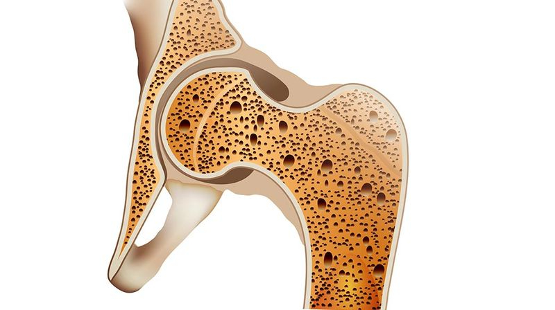 AI精準預測結合骨質整合照護，顧骨本、不骨折有期待圖片取自:(示意圖123rf)