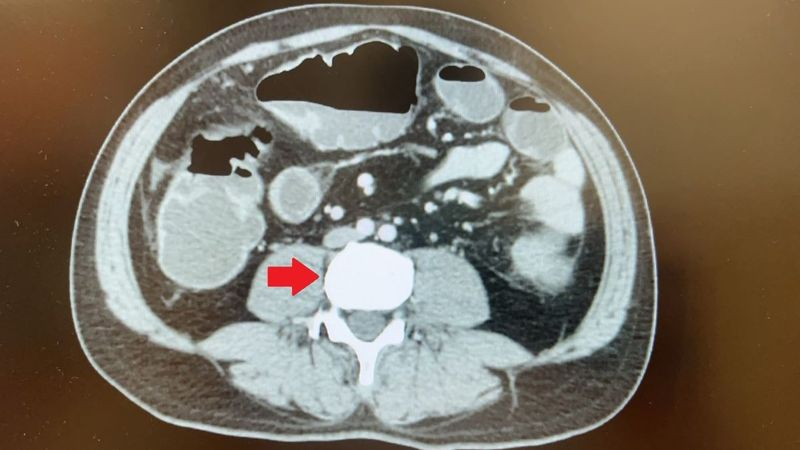 據國健署資料統計，大腸癌連續多年位居國人癌症發生人數之首，電腦斷層檢查看到降結腸處有一顆5公分的大腫瘤造成腸阻塞。（圖/台北慈濟醫院提供。）